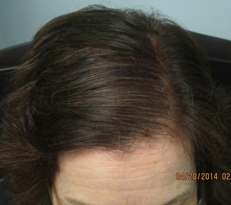 After - Frontal Hairline Restoration