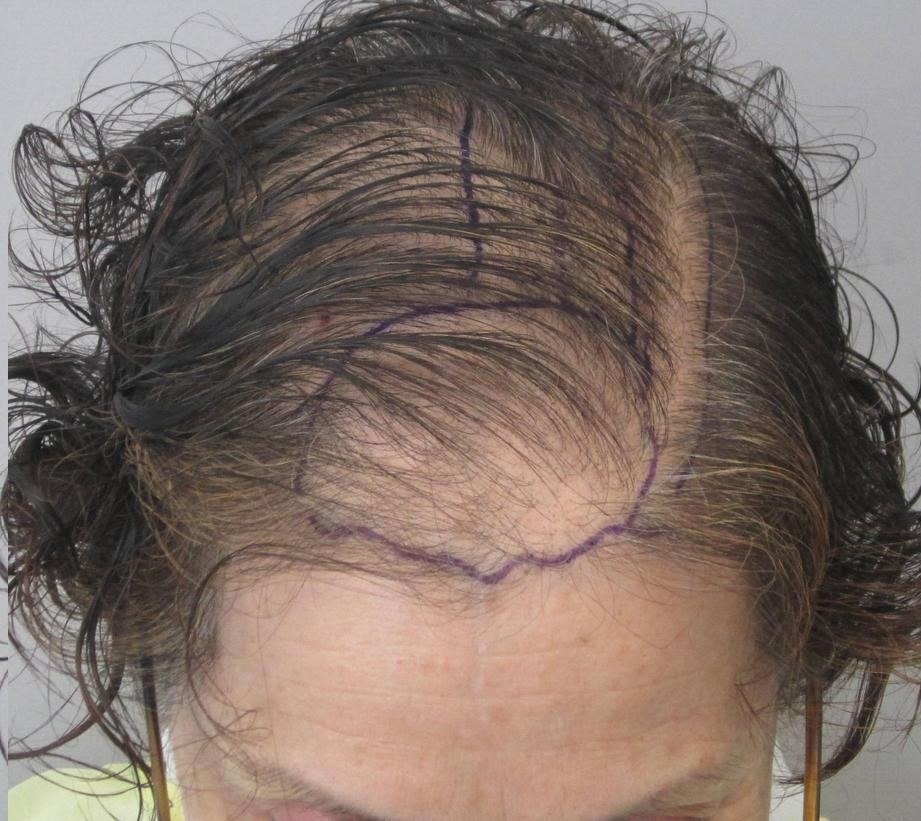Before - Frontal Hairline Restoration