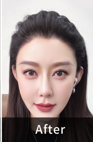 After - Receding Hairline Correction
